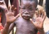 Mpox : Comprendre la maladie et adopter les bons gestes pour se protéger