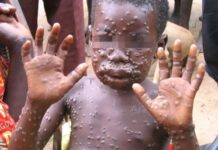 Mpox : Comprendre la maladie et adopter les bons gestes pour se protéger